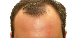 According to the american academy of dermatology (aad), it's normal to. Men Hair Loss Causes Treatments And Solutions