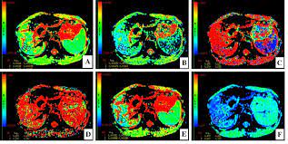 Hepatitis b vaccine is safe and effective but should not be seen as an alternative to a strategy of prevention of transmission. Maps Of A Male 28 Years Old Chronic Hepatitis B G2s1 Patient A Download Scientific Diagram