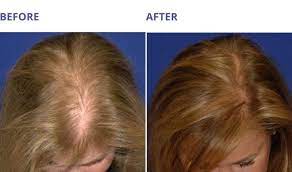 For optimal hair growth and reverse hair loss, the amino acids that provide the most benefits are discussed below. 3 Best Hair Treatments For Damaged Hair And Hair Fall