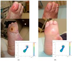 Image result for diabetic toes