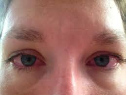 Image result for red eye from crying