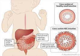 Necrotizing Enterocolitis Nec