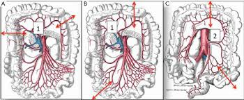 (1) as a temporary procedure to relieve an acute obstruction of the distal colon or to protect a new distal colonic anastomosis and (2) as a permanent procedure for unresectable advanced lesions. Peculiarities Of Intra Thoracic Colon Interposition Eso Coloplasty Indications Surgical Management And Outcomes Gust Annals Of Translational Medicine