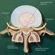 This condition is usually found in patients suffering from a herniated disc, prolapsed disc, extruded disc (or slipped disc) or protruded disc. Ligamentum Flavum Hypertrophy Cause Treatment