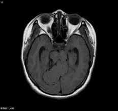 Florida maine shares a border only with new hamp. Radiology Quiz 7796 Radiopaedia Orgviewing Playlist Cns Brain Mri Hard 1 Radiopaedia Org