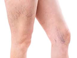 Spider Veins Removal Dr Joycelim Dermatologist Skin Specialist