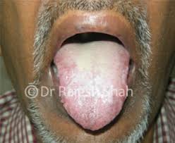 Image result for lichen planus on tongue)