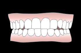 Apr 10, 2021 · another method of underbite correction is a reverse pull face mask or headgear. Underbite Correction Treatment Options Newmouth