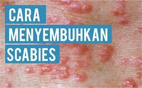 Intense itching occurs in the area where the mite burrows. Bagaimana Cara Menyembuhkan Scabies Khairulleon Com Travel Blogger