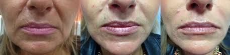 Marionetki to linie, które ciągną się od kącików ust aż. Kwas Hialuronowy Botox Wroclaw Botoks Powiekszanie Ust Botox Usuwanie Zmarszczek Kwas Hialuronowy Wroclaw