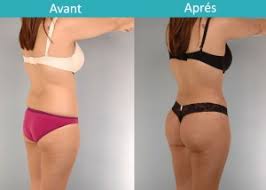 Le lipofilling consiste à prélever de la graisse en excès et de la réinjecter sur une autre zone du corps : Augmentation Fesses Tunisie Prix Lipofilling Fesses Implant Fessier