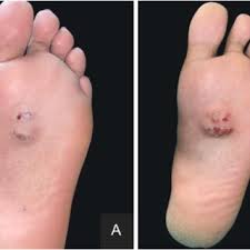 PDF) Plantar Nodular Lesion in A 22‐Year‐Old Immunocompetent Female Patient