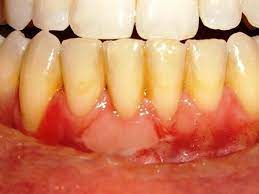 Dental Pro 7 Is Professional Strength Dental Solution For Unhealthy Teeth Gum Problems Receding Gums And Bleedi Bleeding Gum Gum Disease Treatment Gum Health