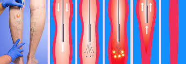 Check spelling or type a new query. Krampfadern Laserablation Schneidet Besser Ab Als Op Und Sklerosierung Medical Tribune