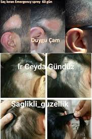 Sac Mantari Iyilesmesinde Buyuk Yardimci Sac Derisinde Olusan Mantar Cok Can Sikici Bir Durumdur Ve Emergency