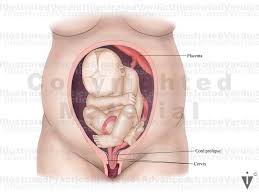 Image result for Breech Presentation