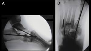 Scielo Brasil Charcot Neuroarthropathy Realignment Of Diabetic Foot By Means Of Osteosynthesis Using Intramedullary Screws Case Report Charcot Neuroarthropathy Realignment Of Diabetic Foot By Means Of Osteosynthesis Using Intramedullary