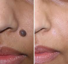 How To Remove A Mole The 5 Most Unusual Remedies Home Remedies For Skin Skin Moles Home Remedies