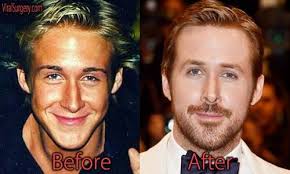 Ryan Gosling Plastic Surgery Before And After Ryangosling Nosejob Nosesurgery Rhinoplasty Beforeafter Plastic Surgery Celebrity Plastic Surgery Nose Job