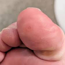 Image result for Chilblains