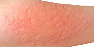 Image result for contact dermatitis