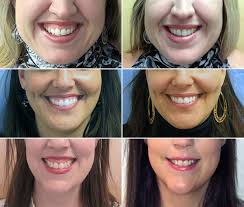 Causes and treatments while your gums are a crucial your mouth, you probably don't want to show them off every time you smile. Bothered By A Gummy Smile The New York Times