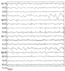 How To Read An Eeg Epilepsy Foundation
