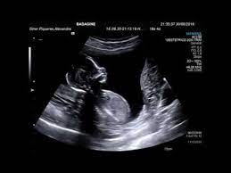 Ecografia 15 Semanas Es Un Chico Imagenes De Ultrasonido 15 Semanas De Embarazo Prueba De Embarazo Positiva