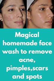 I am getting a lot of queries on acne, pimples, blemishes and scars. Find Out What Are The Top 7 Melaleuca Oil Benefits On Your Health Homemade Face Wash Remove Acne Oil Face Wash