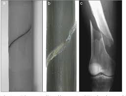 The long bones are those that are longer than they are wide. Pdf A Surrogate Long Bone Model With Osteoporotic Material Properties For Biomechanical Testing Of Fracture Implants Semantic Scholar