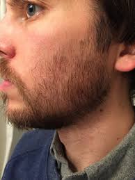 29 years, first attempt growing a full beard, Update: 10 weeks