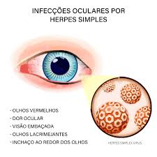 Infecções oculares por Herpes Simples têm tratamento - Portal Comunique-se