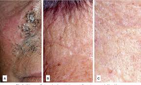 Environmental pollutants can result in a variant of acne called 'chloracne'. Skin Diseases Associated With Agent Orange And Other Organochlorine Exposures Semantic Scholar