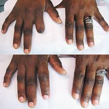 We did not find results for: Finger Prosthesis Hand Prosthesis Milwaukee Wi Life Like Prosthetics