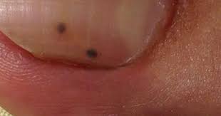 Check spelling or type a new query. Black Spot Under Toenail Black Spot Under Toenail Black Toe Nails Toe Nails