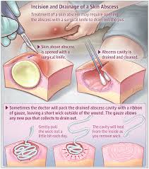 Skin Abscess Wound Care Wound Care Nursing Medical Information