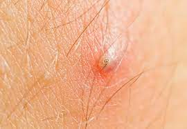 Sometimes it only takes around a month, according to the mayo clinic. Q A Expert Explains Best Way To Handle Your Ingrown Hair Cleveland Clinic