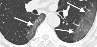 CT Imaging Features of 2019 Novel Coronavirus (2019-nCoV)Radiology