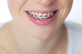 A great tip for how to tell if you need braces is to see if you have an underbite. Do I Really Need Braces Again Dr Harrison Dds