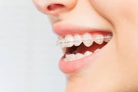 Most kids will still receive braces between the ages of 10 and 14, after all of their permanent teeth have come in. Can You Get Bottom Braces Only Suffolk Pediatric Dentistry