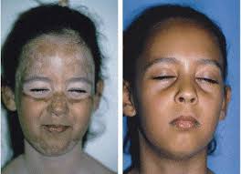 Treatment of generalized vitiligo in children with narrow-band (TL-01) UVB  radiation therapy