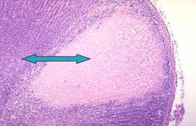 Image result for Renal Infarction