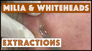 White bumps on forehead may be treated effectively at home by using a combination of good skincare and hygiene practices and also topical creams. Milia And Whiteheads Extracted On The Face Youtube