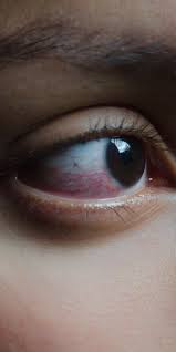 I was keeping my eye on allen. What Exactly Causes Red Eyes That Look All Bloodshot Self