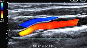 A ecografia ou ultrassonografia é, basicamente, uma modalidade de diagnóstico por imagem que utiliza o som para obter imagens e é um método que vem. Doppler Colorido X Leme Diagnostico Por Imagem