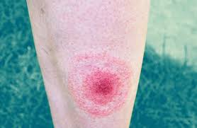What Does A Lyme Disease Rash Really Look Like These Pictures Explain It Health In 2020 Lyme Disease Lyme Types Of Rashes