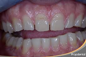 We did not find results for: Bruxismo Como Tratar El Apretamiento Y Rechinar De Los Dientes