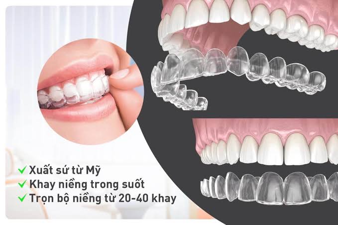 Niềng răng trong suốt