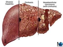 Circa 6 anni fa durante un'ecografia addominale mi hanno diagnosticato la presenza di due polipi alla colecisti il maggiore di 5mm. Cirrosi Epatica E Fegato Sintomi Dieta Diagnosi Terapia E Prevenzione Medicina Online