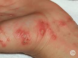 Image result for scabies norvegica